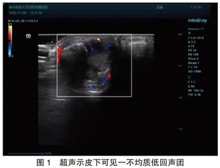 超声诊断局限性腱鞘巨细胞瘤1例
