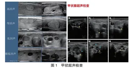 超声诊断甲状腺癌的价值分析