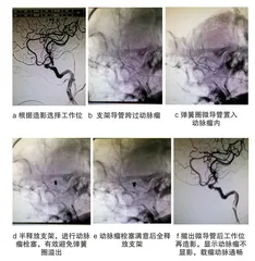 Lvis支架辅助弹簧圈栓塞治疗破裂宽颈颅内动脉瘤及对神经功能及预后的影响