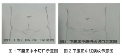 下腹正中腹横纹小切口在双侧腹股沟疝无张力修补术中的临床应用1