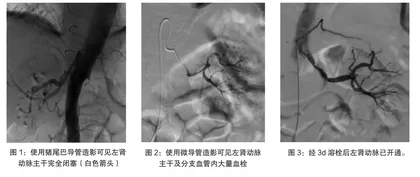 介入置管溶栓术在急性肾动脉栓塞治疗中的临床应用