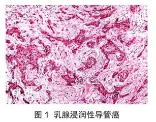 乳腺包块穿刺标本病理活体组织检查与诊断的分析3