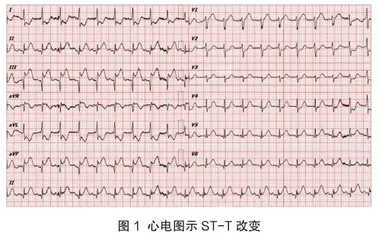 学龄期儿童急性心肌梗死1例