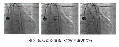学龄期儿童急性心肌梗死1例2
