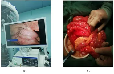 经腹腹膜前疝修补术术后肠梗阻1例病例分析