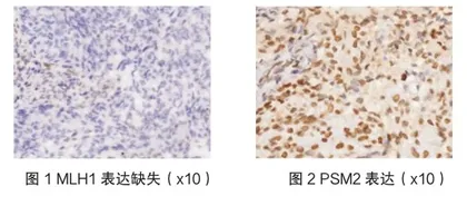 子宫内膜癌患者错配修复MMR蛋白的表达