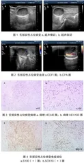 罕见舌神经鞘瘤超声表现1例1