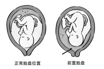 孕期前置胎盘的风险