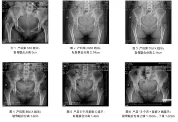 1例阴道分娩后耻骨联合分离患者的治疗