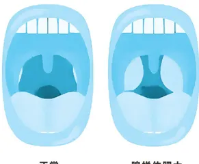 鼻涕倒流与腺样体肥大有何关联 