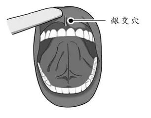 痔疮频发，龈交穴来帮忙！