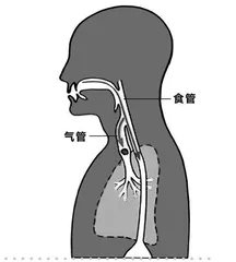 “误吸”非小事，大家需重视