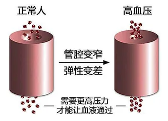 高血压遇上感冒，用药需慎重