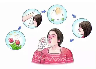 三甲医院药师教你用抗过敏药