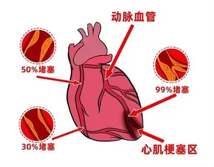 心梗发作时，看病别“货比三家”