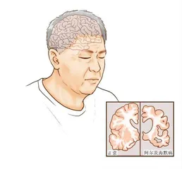 别让“假痴呆”变成“真痴呆”