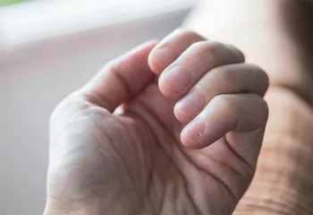 拔倒刺、舔嘴唇，小心因小失大伤自己