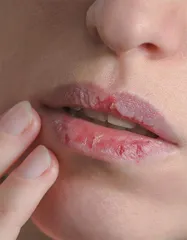 拔倒刺、舔嘴唇,小心因小失大伤自己1
