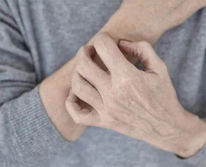 长期皮肤瘙痒，一查竟是严重肝病2