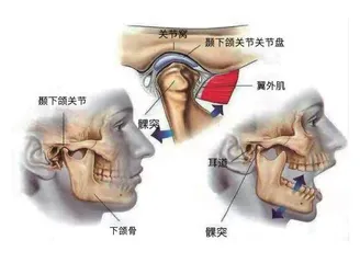 “有口难开”？小心是颞下颌关节紊乱综合征1