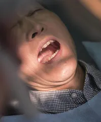 口腔溃疡经久不愈,别忽视口腔癌3