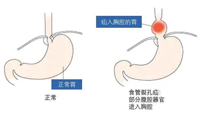 胃进胸腔，警惕老年人高发的食管裂孔疝1