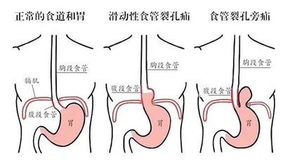 胃进胸腔，警惕老年人高发的食管裂孔疝2