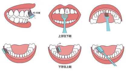 警惕“刷”出来的牙病2
