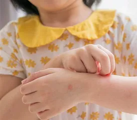 孩子总过敏，要当心过敏体质2