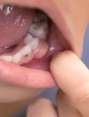 还没换牙的孩子，得了蛀牙怎么办1