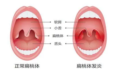 “不好伺候”的扁桃体2