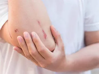 小小瘢痕，为何可能变成癌1