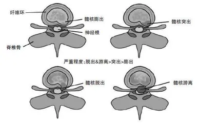 了解腰椎间盘突出症选择正确治疗方式