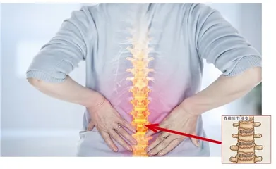 “不死之癌”——强直性脊柱炎