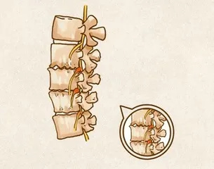 骨刺：似病非病，因人而异