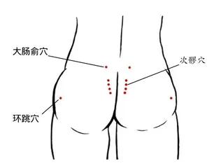 如坐针毡——警惕坐骨结节滑囊炎1