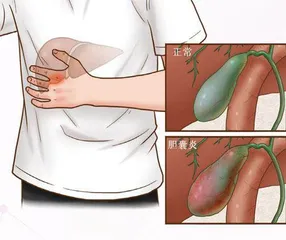 超声检查在青少年胆囊炎中的应用