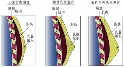 青青期男性乳腺发育怎么办?1