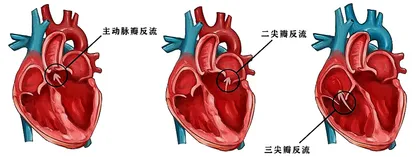 心脏三尖瓣发生反流该怎么办？