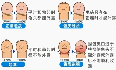 包皮过长或包茎应该怎么办？1