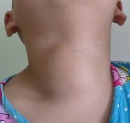 超声检查在儿童青少年颈部肿物诊断中的作用