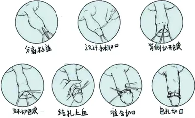 包皮过长或包茎应该怎么办？2