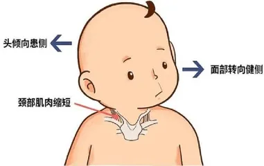 了解小儿斜颈，助力孩子健康成长