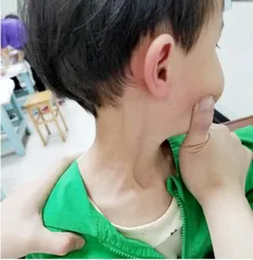 了解小儿斜颈，助力孩子健康成长1