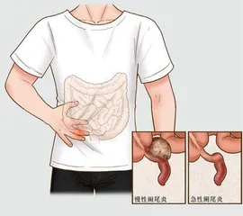 青少年腹痛应警惕急性阑尾炎