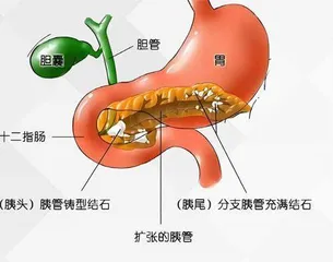 青少年胰管结石的外科治疗