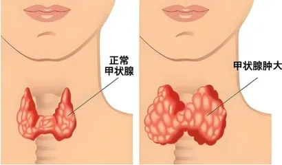 儿童甲状腺炎不容小觑