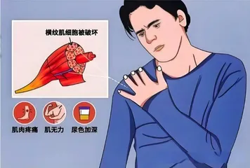 大量运动后需警惕横纹肌溶解综合征