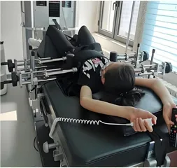 青少年特发性脊柱侧弯的筛查、预防和治疗