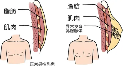 揭开男性青春期乳房发育的神秘“面纱”